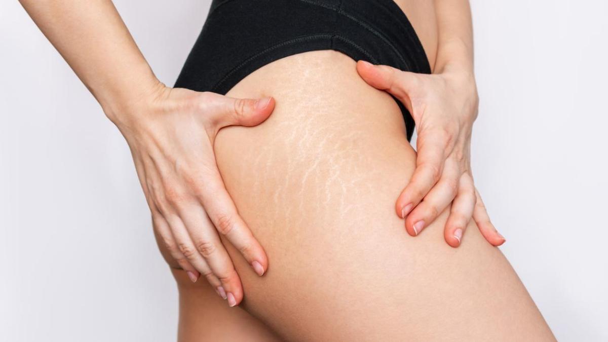 Este aceite arrasa entre las mujeres porque previene, reduce y repara estrías, cicatrices y marcas