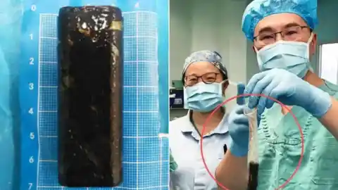 Imagen 1 de Pasa 34 años con un mechero en su estómago, los médicos se lo extraen y todavía funciona