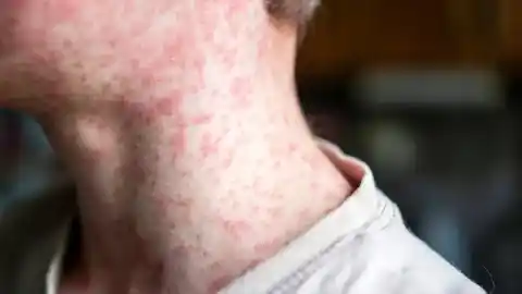 Imagen 1 de Un brote de sarampión deja 21 personas afectadas en La Palma y Gran Canaria