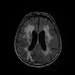 Imagen 1 de Más allá de la resaca: tres copas al día pueden adelantar 11 años un ictus hemorrágico