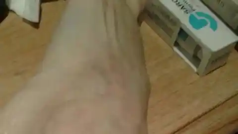 Imagen 1 de Detectan un brote de sarna en la residencia de personas mayores Condes d'Urgell de Balaguer