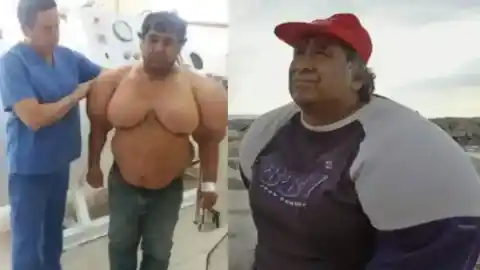 Imagen 1 de Un accidente de buceo causa que el cuerpo de un hombre se hinche y los médicos no saben cómo solucionarlo