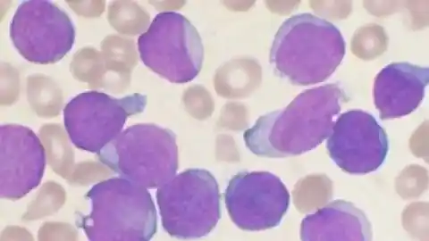 Imagen 1 de Desarrollan una nueva terapia prometedora para pacientes con leucemia linfoblástica de células T