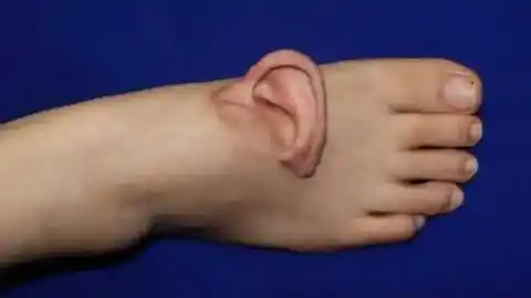 Imagen 1 de Una mujer lleva una oreja en su pie durante cinco meses antes de volvérsela a implantar