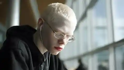 Imagen 1 de Un estudio analiza la discapacidad visual del albinismo y apunta avances para mejorar la visión