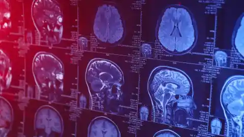 Imagen 1 de Un adolescente chino se convierte en la persona más joven de la historia diagnosticada con alzhéimer