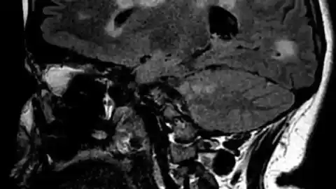 Imagen 1 de Otro estudio apunta a la relación entre el virus de la mononucleosis y la esclerosis múltiple