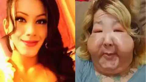 Imagen 1 de Una 'influencer' se somete a una reconstrucción facial tras una deformidad por una operación clandestina